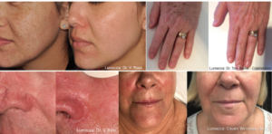 Aspire lucmmea 3 Lumecca IPL