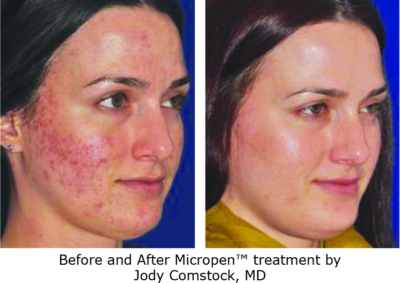 MP-ba-acne 1 micropen before & after