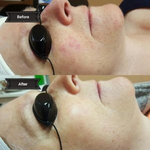 celluma 2 Celluma light therapy before & after