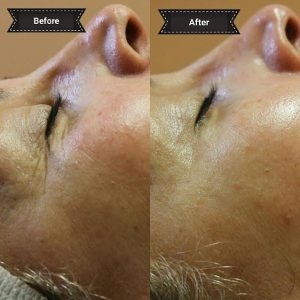 celluma 3 before & after Celluma therapy