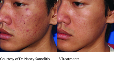 mp_ba_acne _3 3 treatments before & after